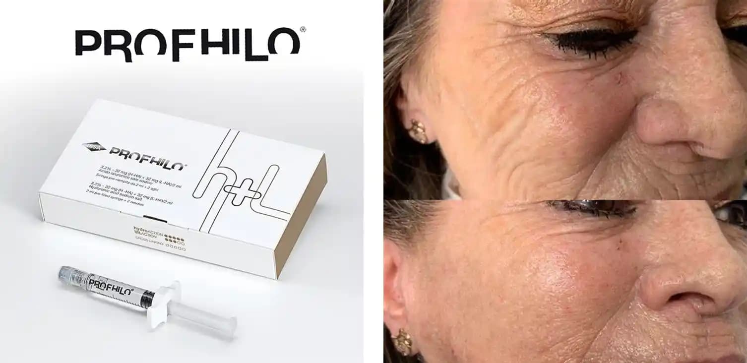 Profhilo ile Teknoloji Kullanıcıları İçin Yenilikçi ve Doğal Cilt Bakımı Yaklaşımı